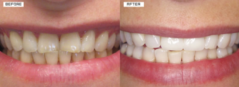 veneers1